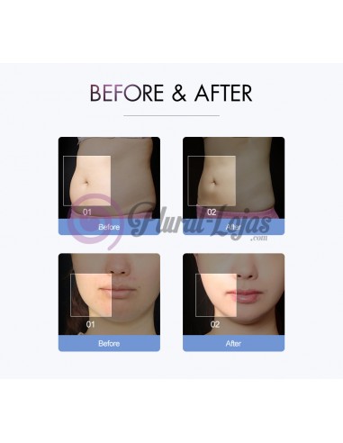 MAQUINA S SHAPE CAVITAÇÃO + RADIOFREQUENCIA | Virtualvantagem | VRT.001.00028