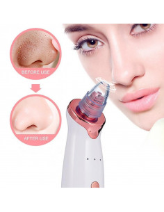 REMOVEDOR PONTOS NEGROS MICRODERMOABRASÃO | Virtualvantagem | VRT.002.00143 2